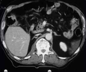 Multi-trauma-small liver-spine fx-3